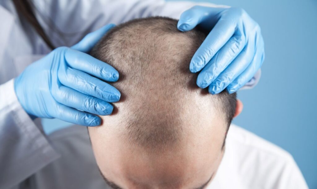 the journey of a successful hair transplant