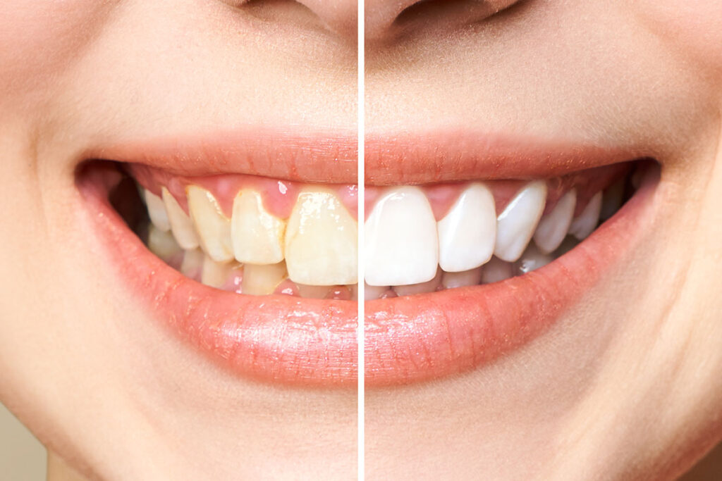 about teeth whitening