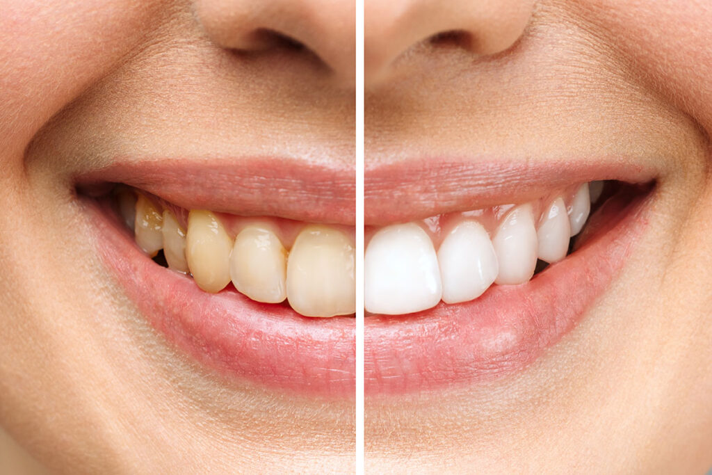 professional teeth whitening