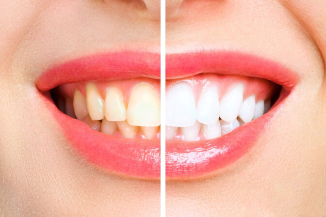 The Ultimate Guide to Effective Teeth Whitening