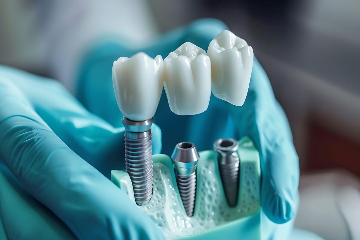 Restore Your Smile with FlashCureMed Dental Implants